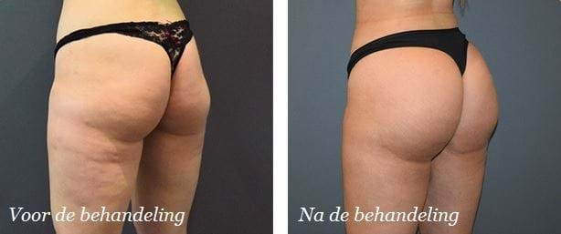 liposuctie voor en na 