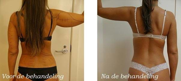liposuctie voor en na armen