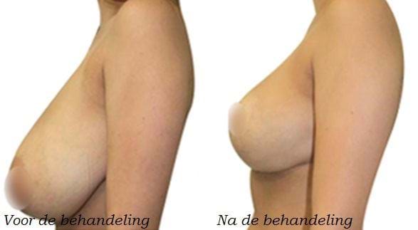 liposuctie borsten voor en na