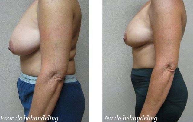 liposuctie borsten voor en na 