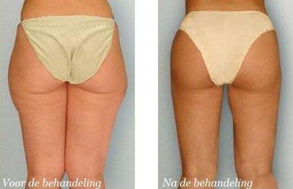 liposuctie bovenbenen voor en na 