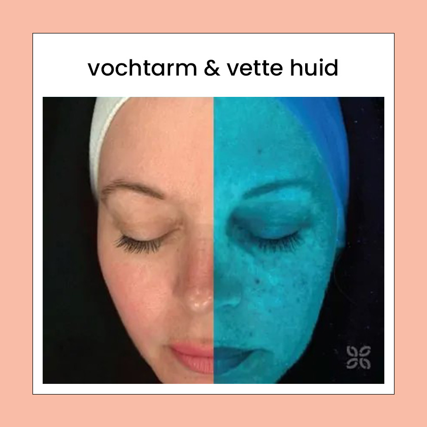 Vochtarme & vette huid