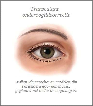 onderooglidcorrectie